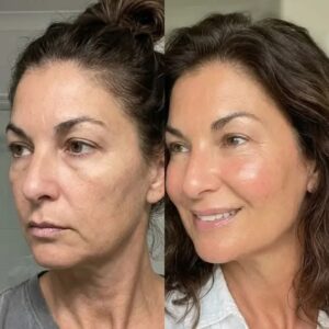 Cheek Filler Before and After 2026