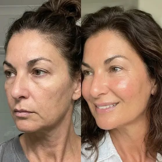 Cheek Filler Before and After 2026