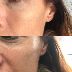 How Long Does Cheek Filler Take to Settle