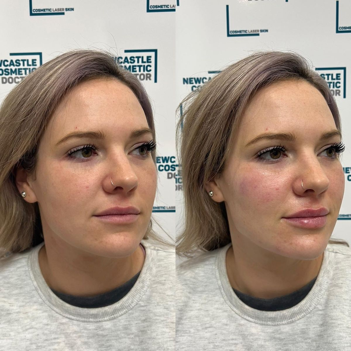 2ml Cheek Filler Volume Restore Before and After