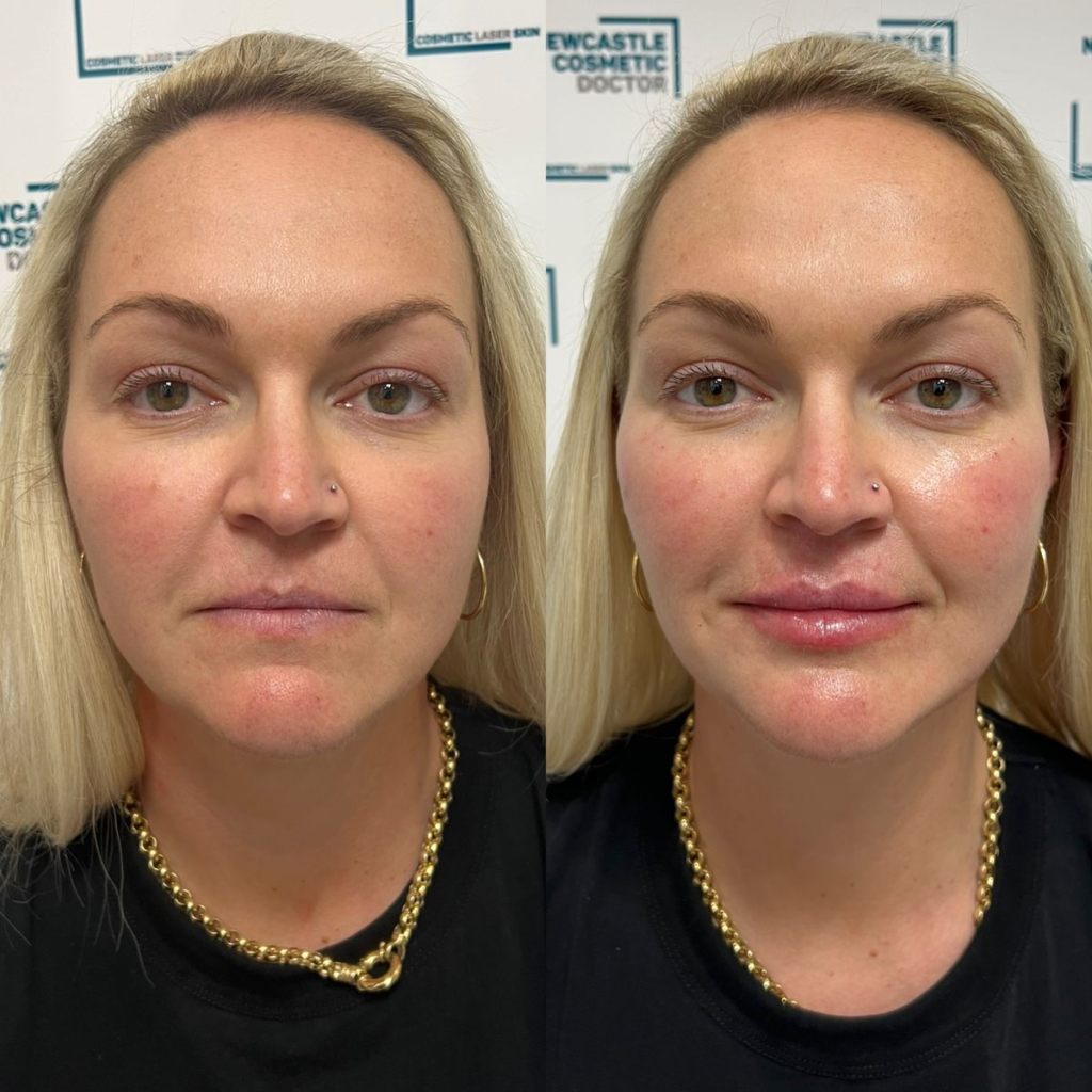 Cheek Filler BEFORE AND AFTER 1ML