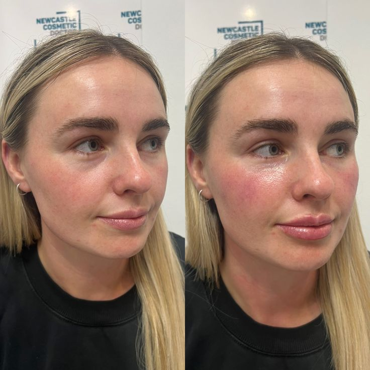 1ml Cheek Filler Before And After