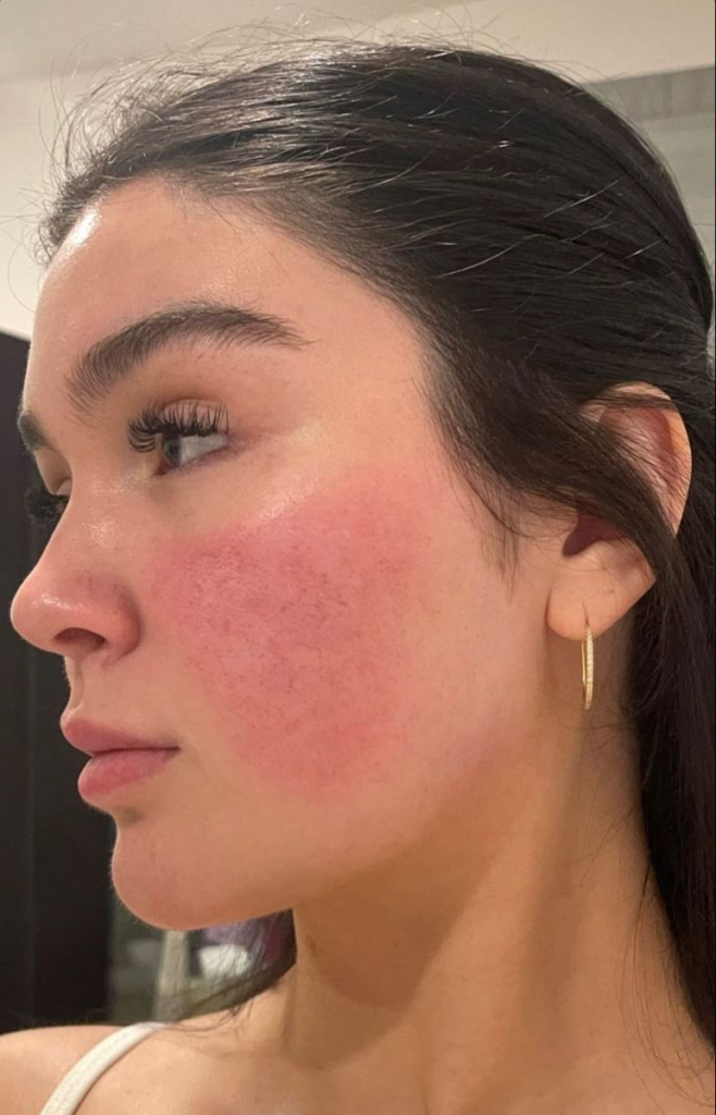 Managing initial swelling
