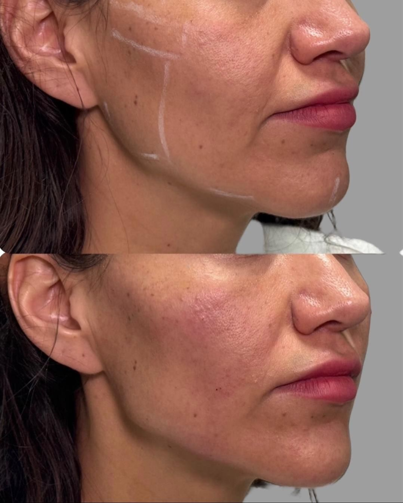 Cheek Filler Refining stage