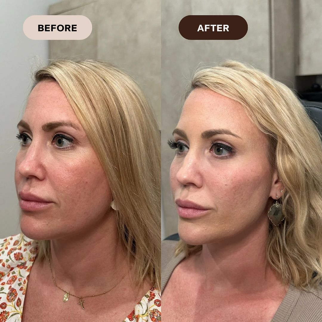 1ml Cheek Filler Subtle Lift Before and After